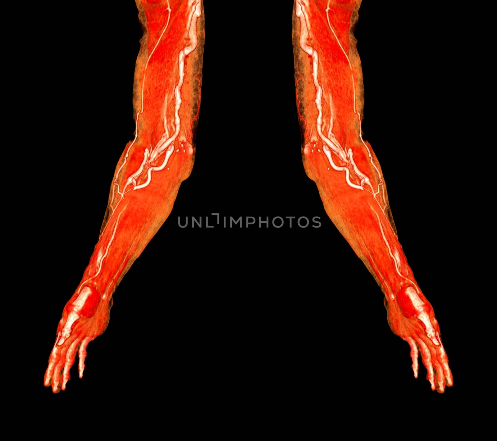 Brachial Arteries of the arm with Upper extremity Bone 3D rendering from CT Scanner.