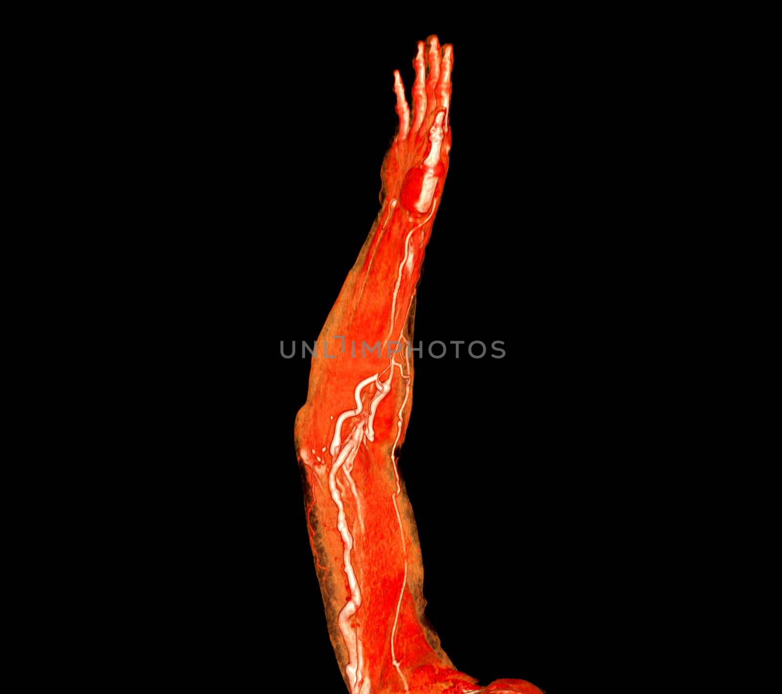 Brachial Arteries of the arm with Upper extremity Bone 3D rendering from CT Scanner.