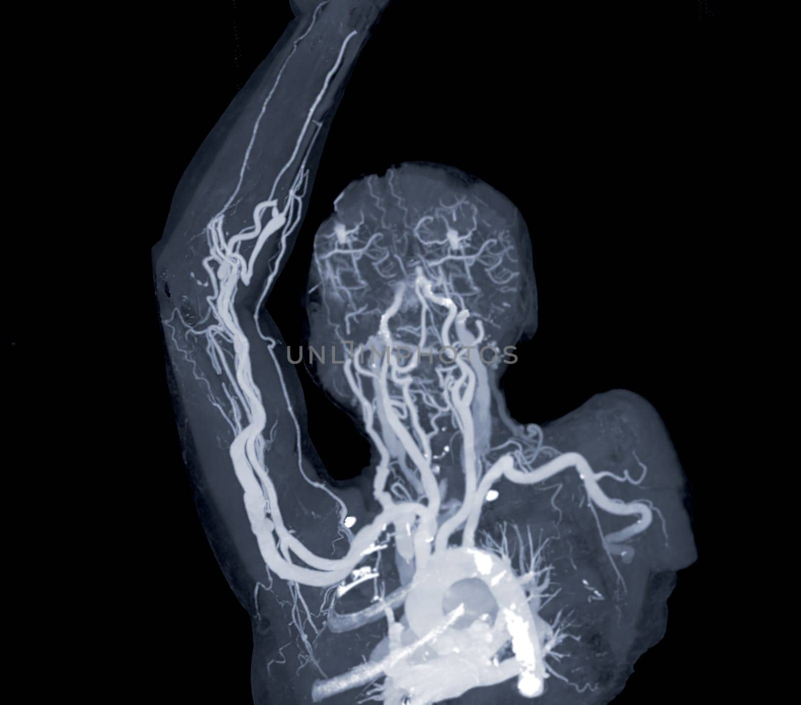 Brachial Arteries of the arm with Upper extremity Bone 3D rendering from CT Scanner.