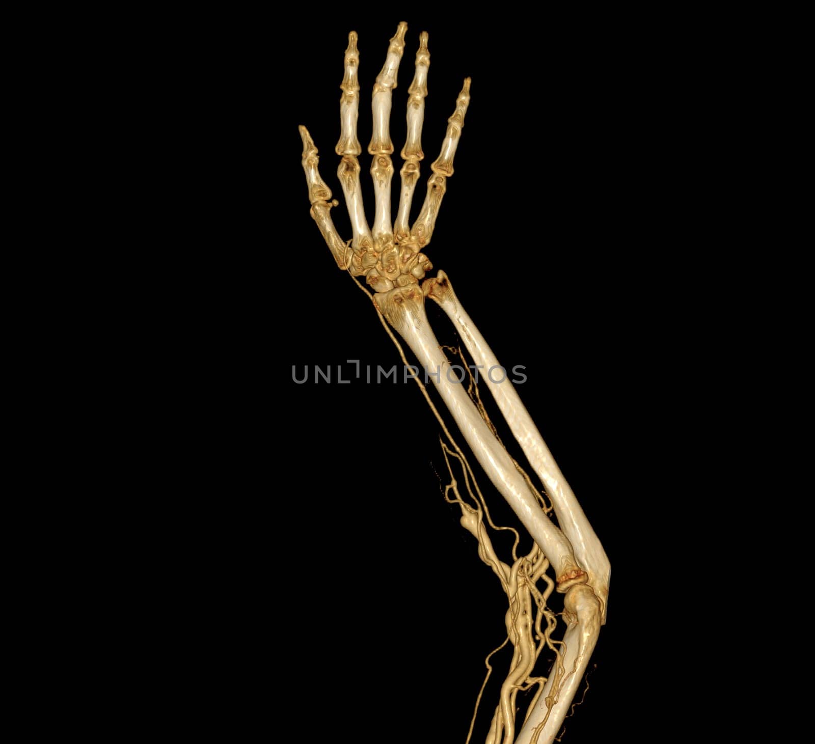 Brachial Arteries of the arm with Upper extremity Bone 3D rendering from CT Scanner. by samunella