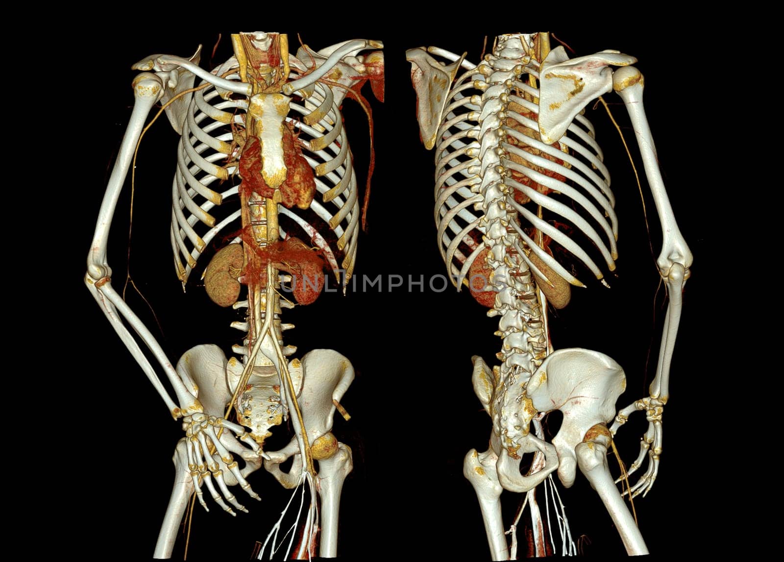 CTA whole aorta and brachial artery 3D rendering image in case patient tramatic.