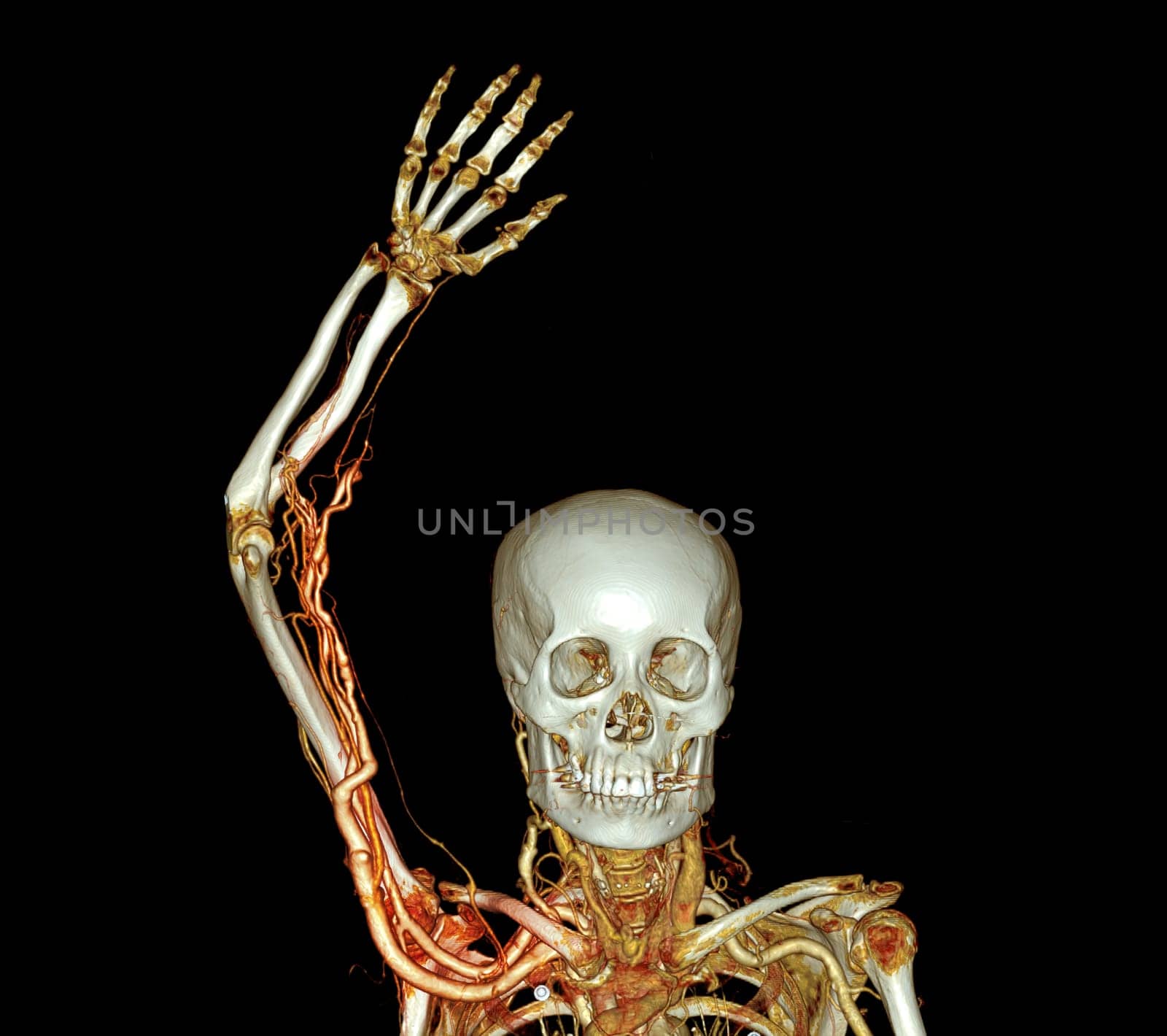 Brachial Arteries of the arm with Upper extremity Bone 3D rendering from CT Scanner.