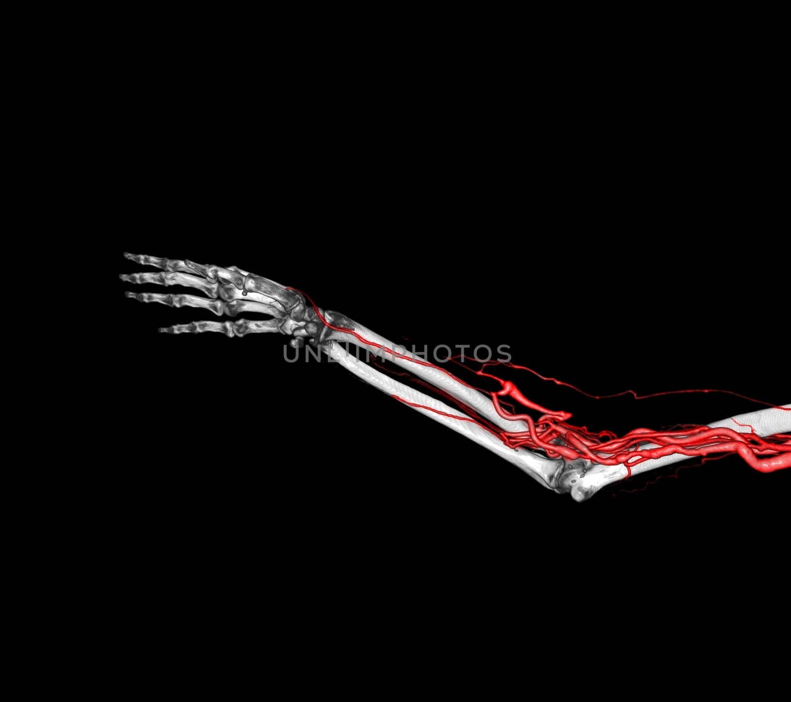 Brachial Arteries of the arm with Upper extremity Bone 3D rendering from CT Scanner.