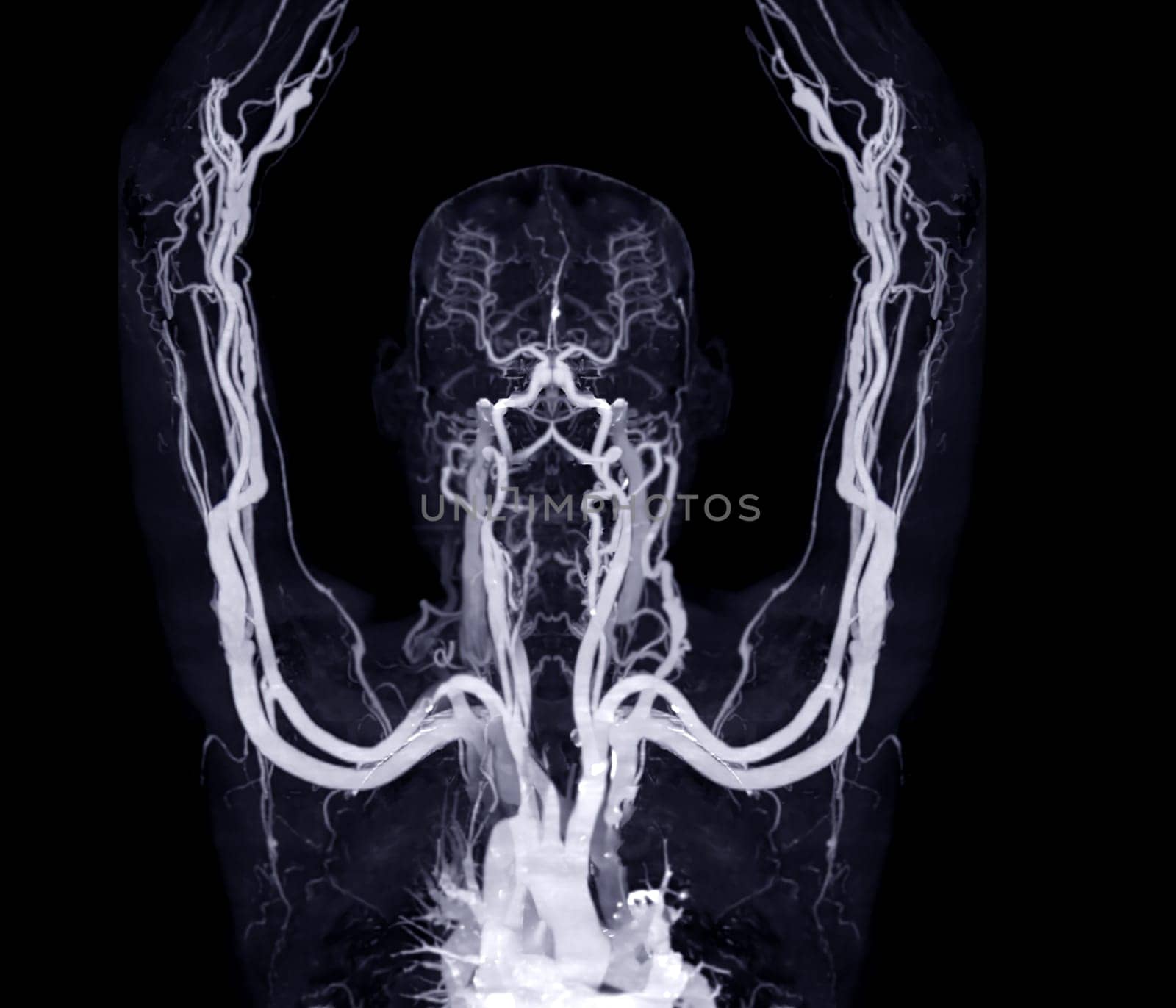 Brachial Arteries of the arm with Upper extremity Bone 3D rendering from CT Scanner. by samunella