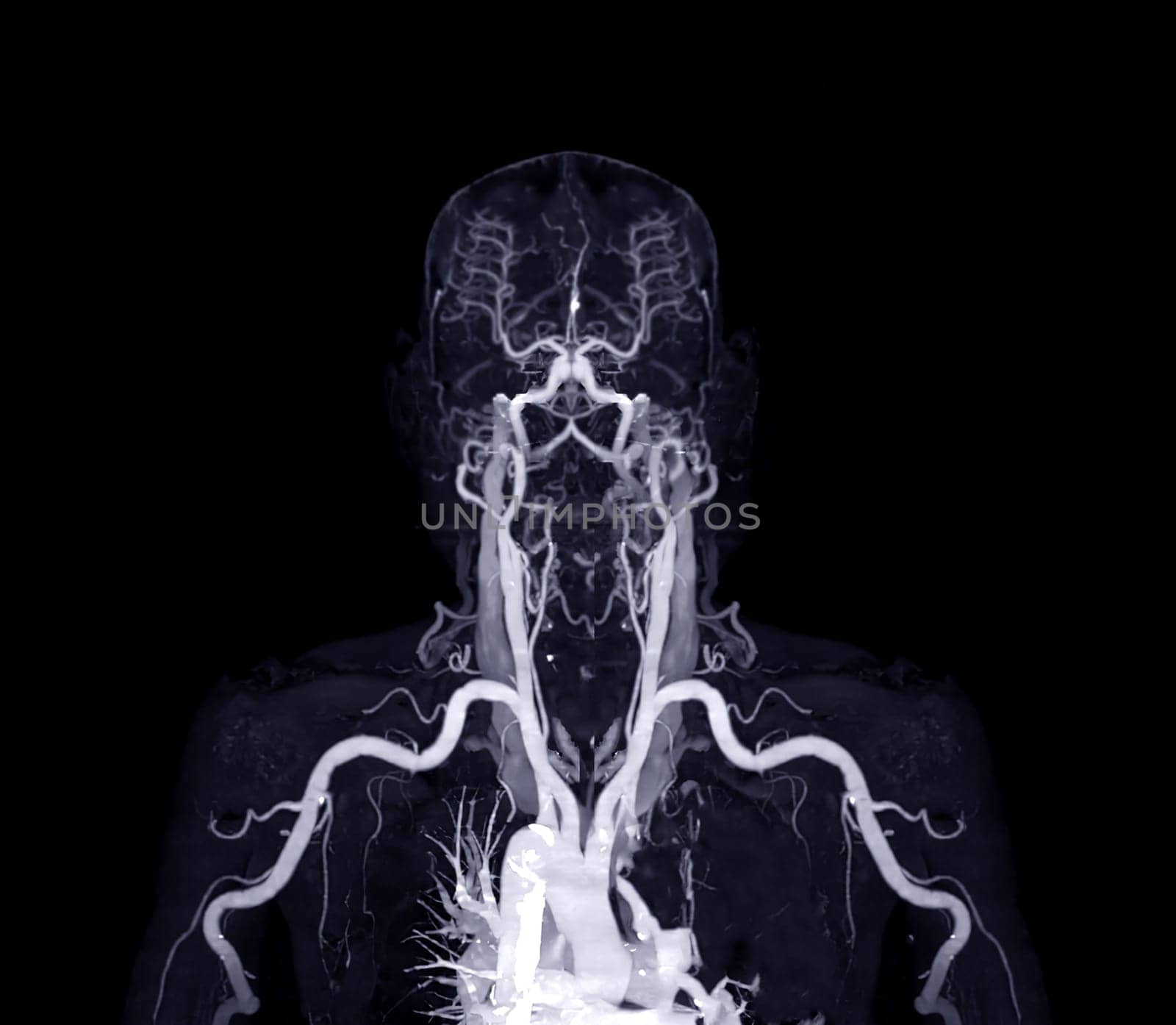 Brachial Arteries of the arm with Upper extremity Bone 3D rendering from CT Scanner.