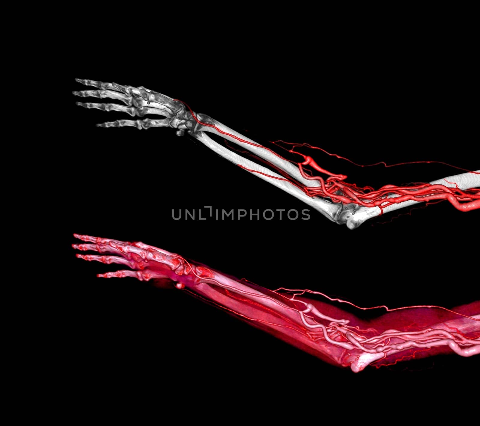 Brachial Arteries of the arm with Upper extremity Bone 3D rendering from CT Scanner.