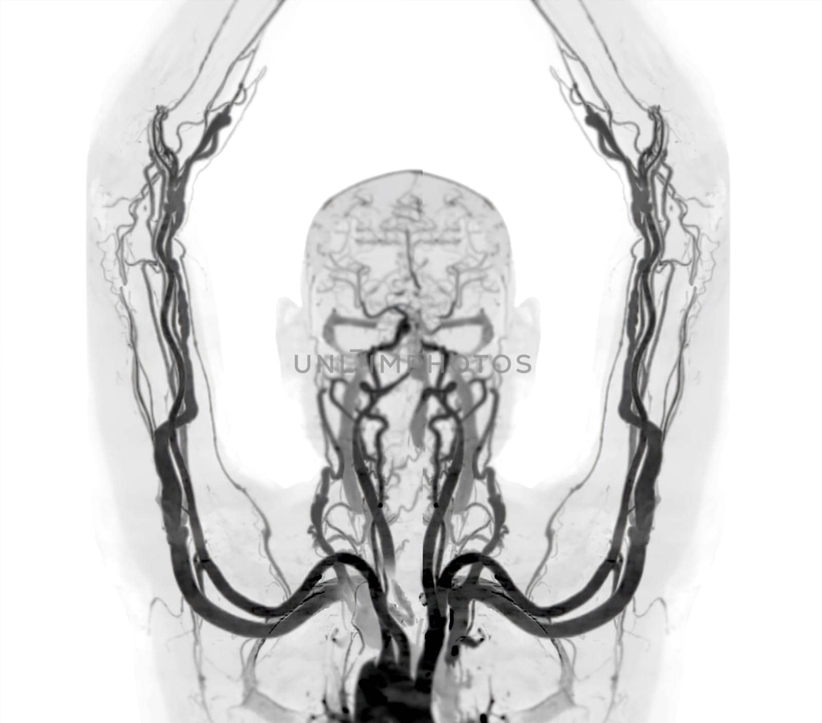 Brachial Arteries of the arm with Upper extremity Bone 3D rendering from CT Scanner.