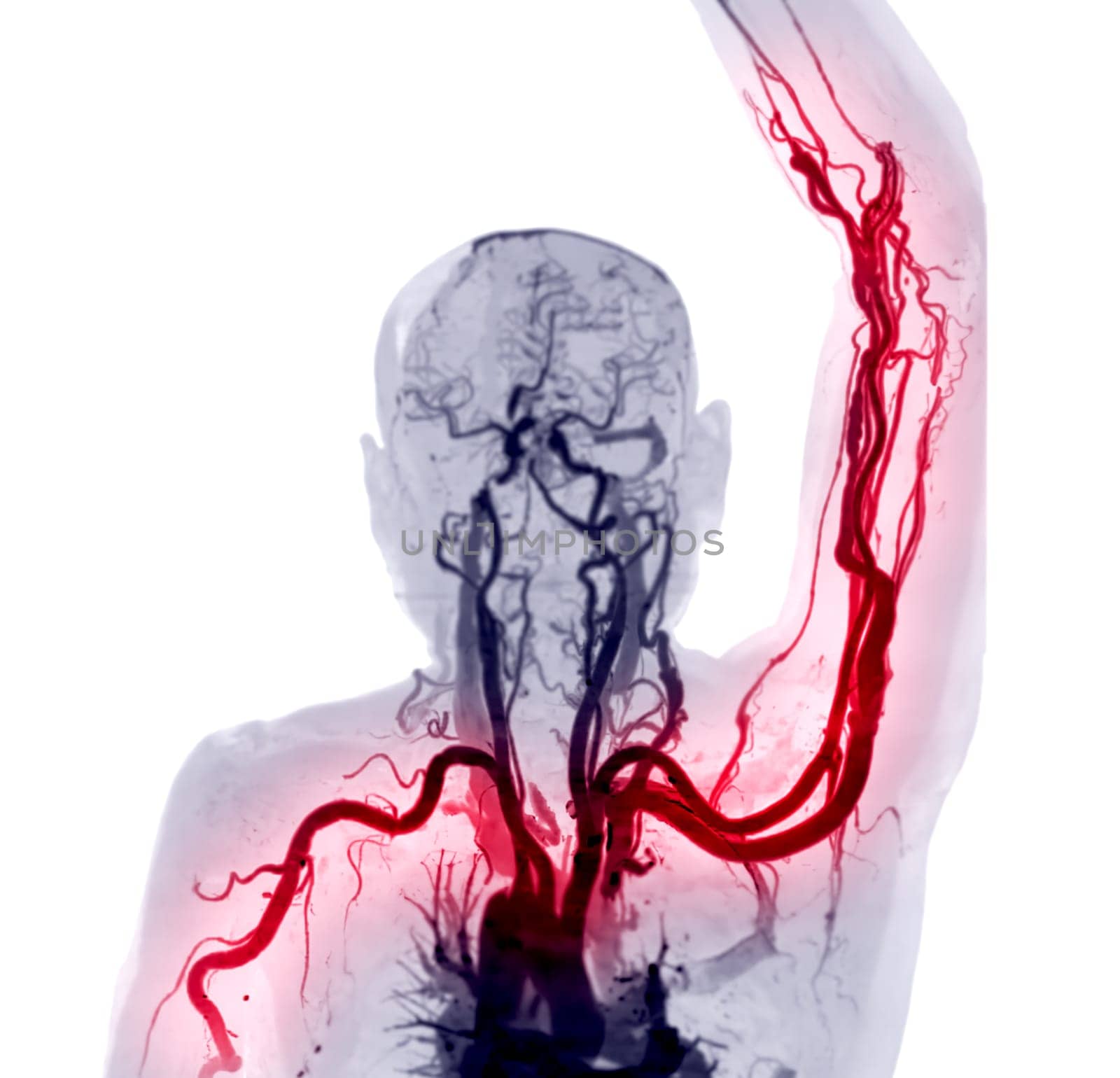 Brachial Arteries of the arm with Upper extremity Bone 3D rendering from CT Scanner.