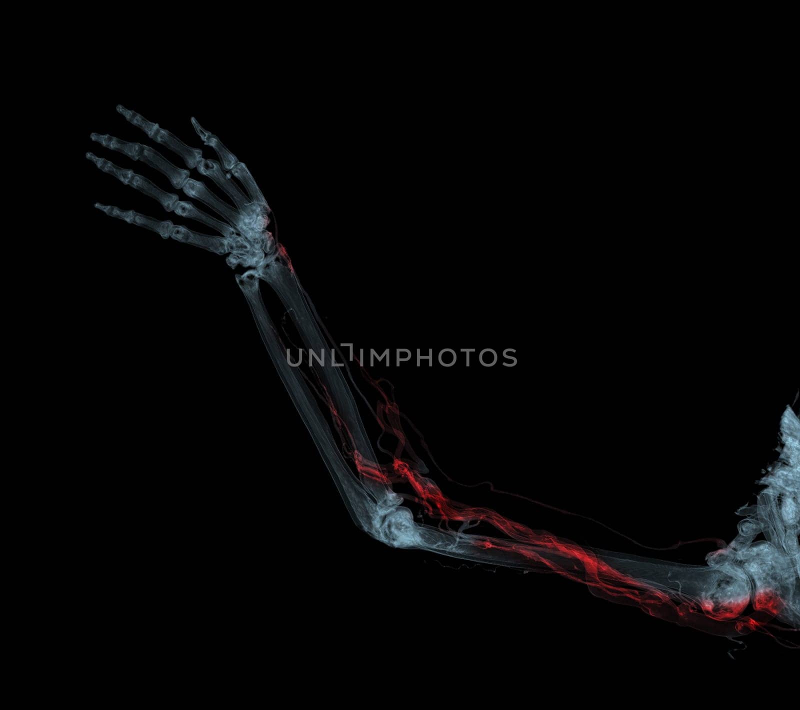 Brachial Arteries of the arm with Upper extremity Bone 3D rendering from CT Scanner.