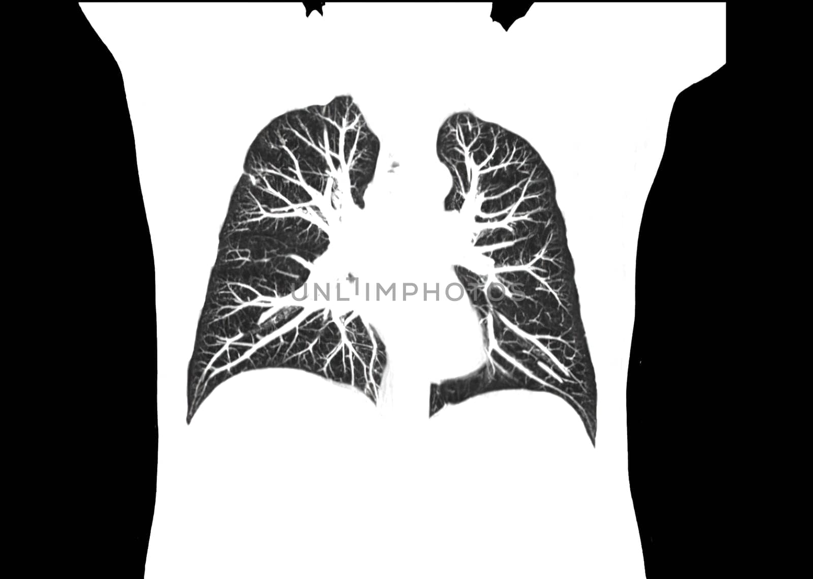 CT scan of Chest or lung coronal view at radiology department in hospital. Covid-19 scan body xray test detection for covid virus epidemic spread concept