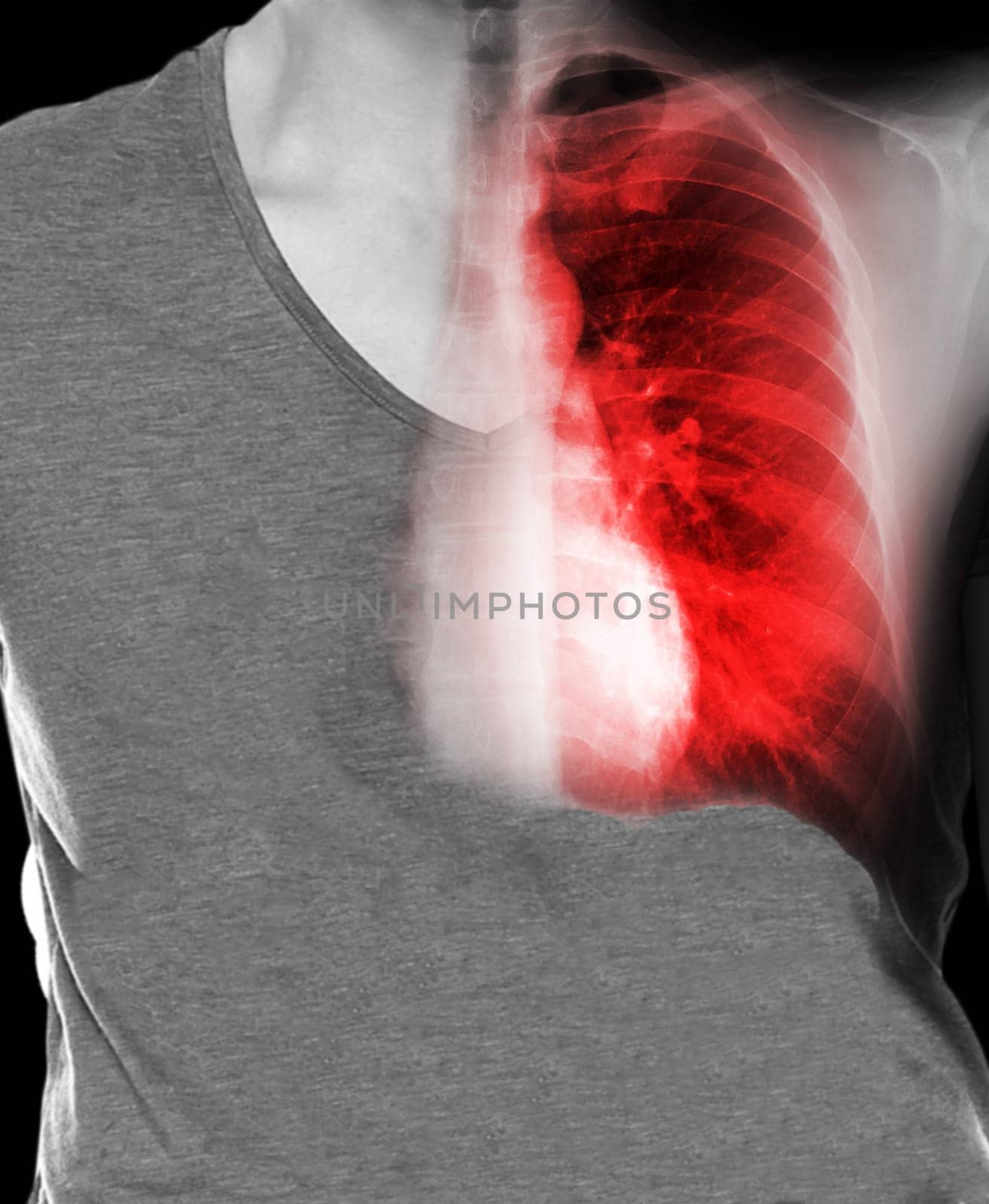 Human Chest With X-ray Chest Imaging.