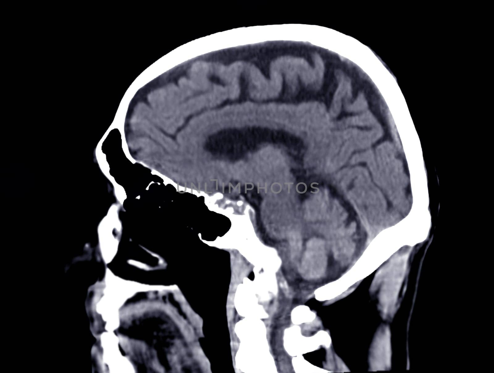 CT scan of the brain sagittal view for diagnosis brain tumor,stroke diseases and vascular diseases.