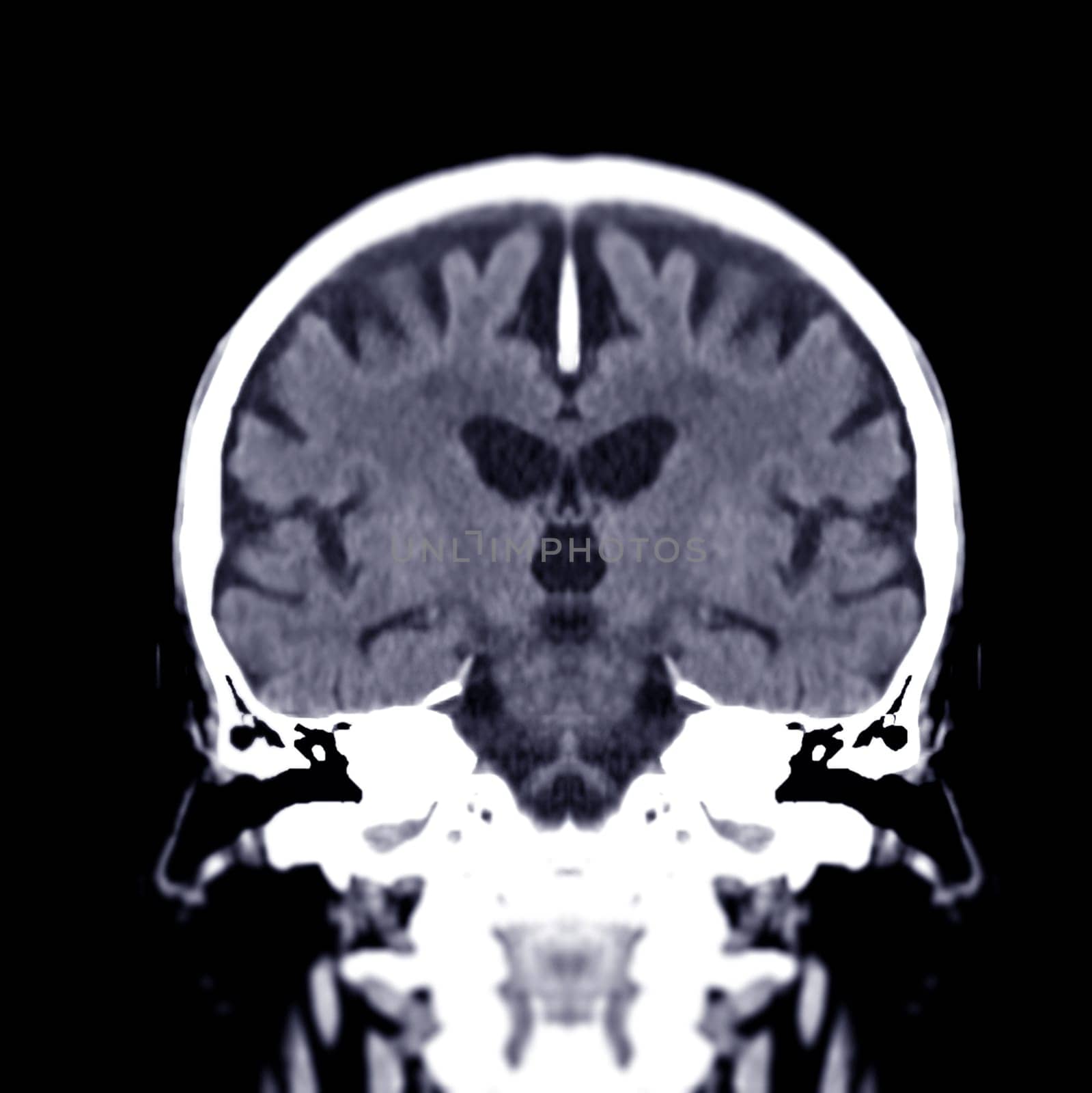 CT scan of the brain Coronal view for diagnosis brain tumor,stroke diseases and vascular diseases.