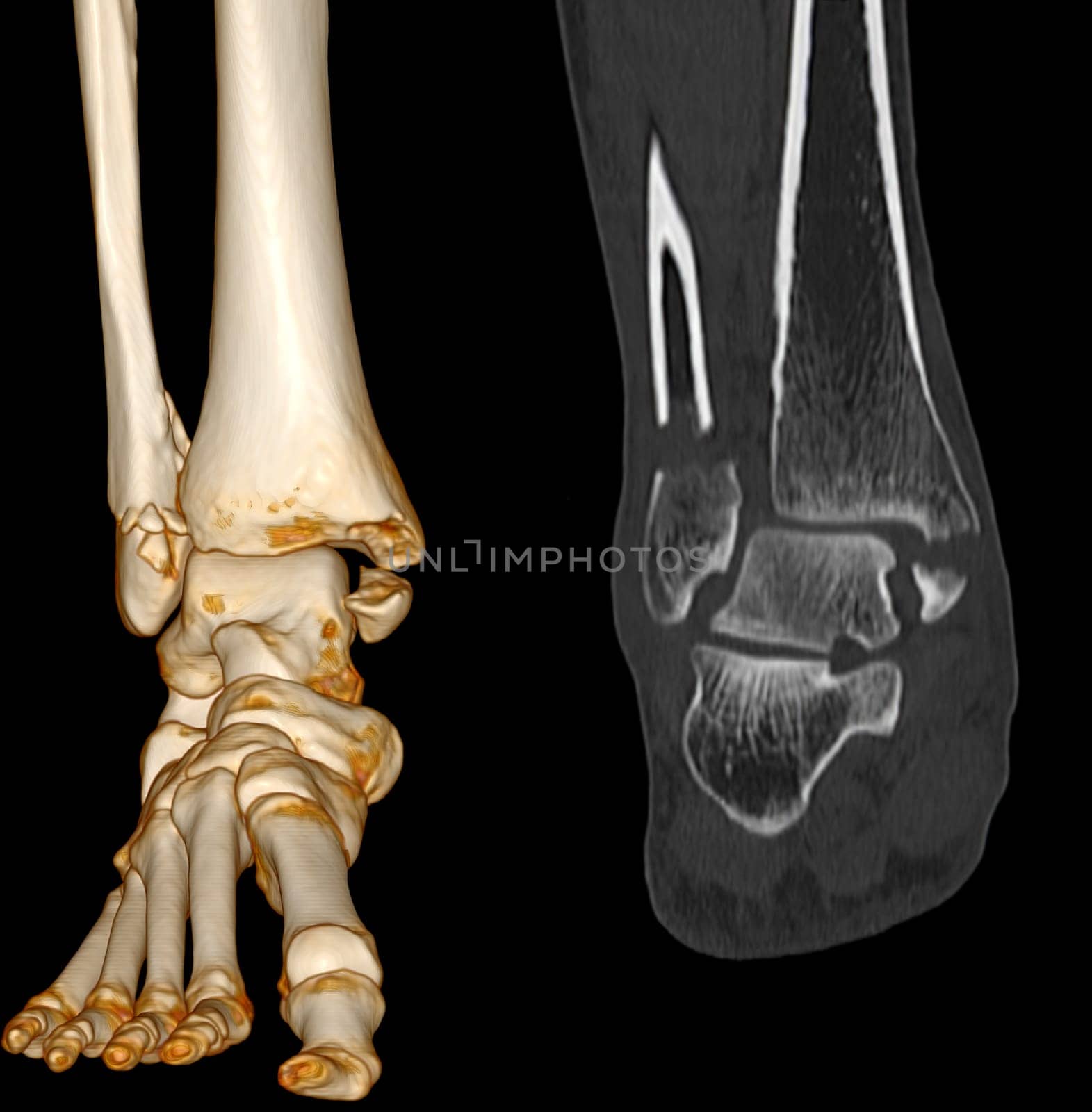 CT Scan ankle and foot or Computed Tomography of Ankle joint and Foot 3Drendering image showing fractured Tibia and fibula bone.