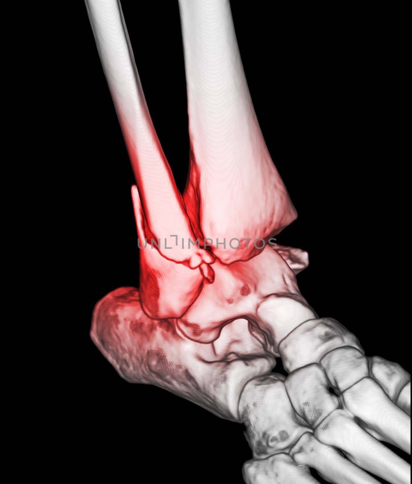 CT Scan ankle and foot or Computed Tomography of Ankle joint and Foot 3Drendering image showing fractured Tibia and fibula bone.