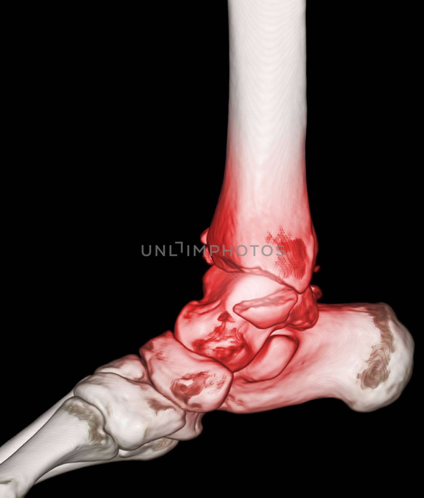 CT Scan ankle and foot or Computed Tomography of Ankle joint and Foot 3Drendering image showing fractured Tibia and fibula bone.