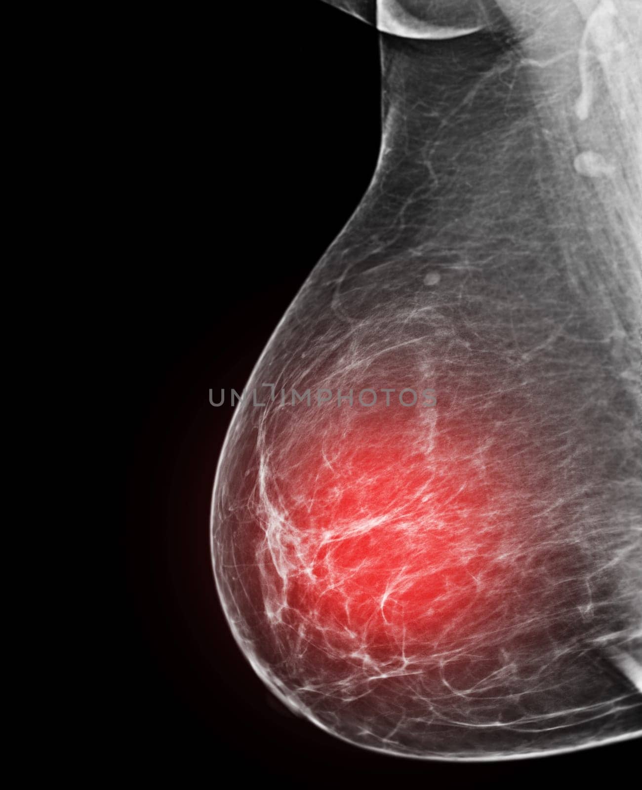 X-ray Digital Mammogram or mammography of both side breast Standard views are mediolateral oblique (MLO) views for screening Breast cancer and evidence of malignancy .