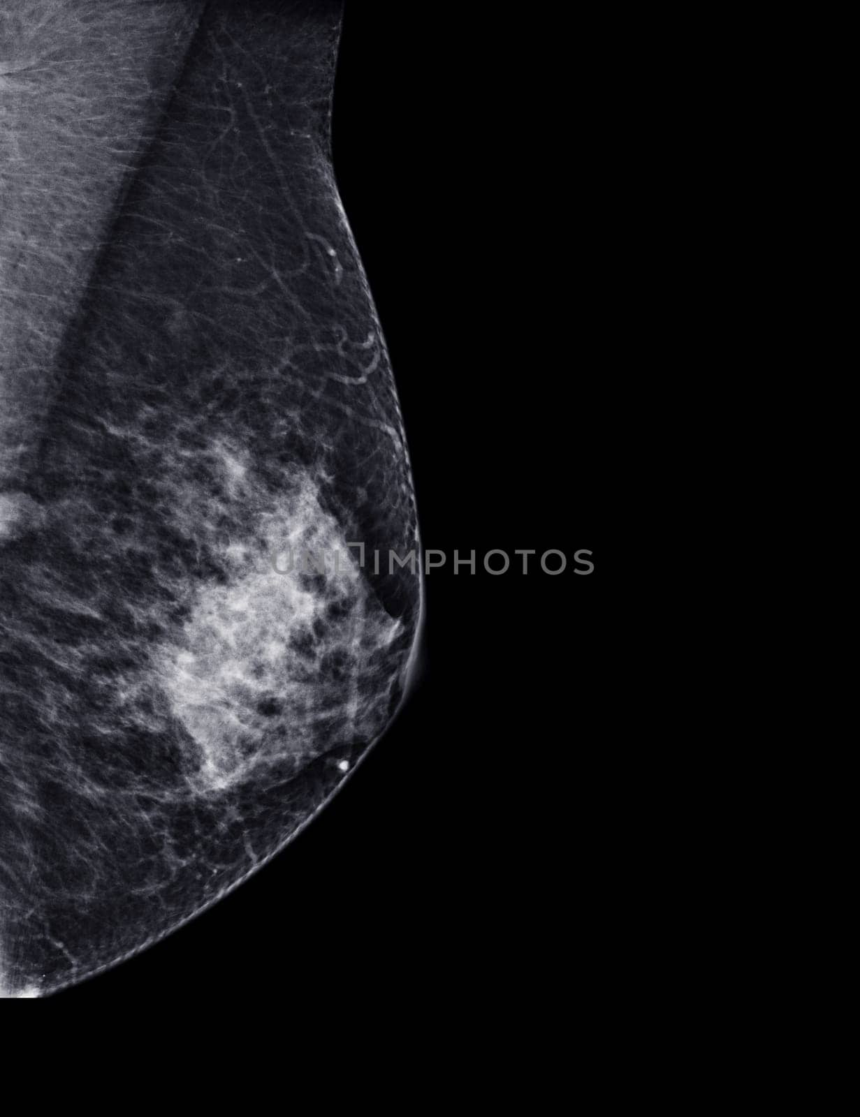 X-ray Digital Mammogram or mammography of both side breast Standard views are mediolateral oblique (MLO) views for screening Breast cancer and evidence of malignancy .