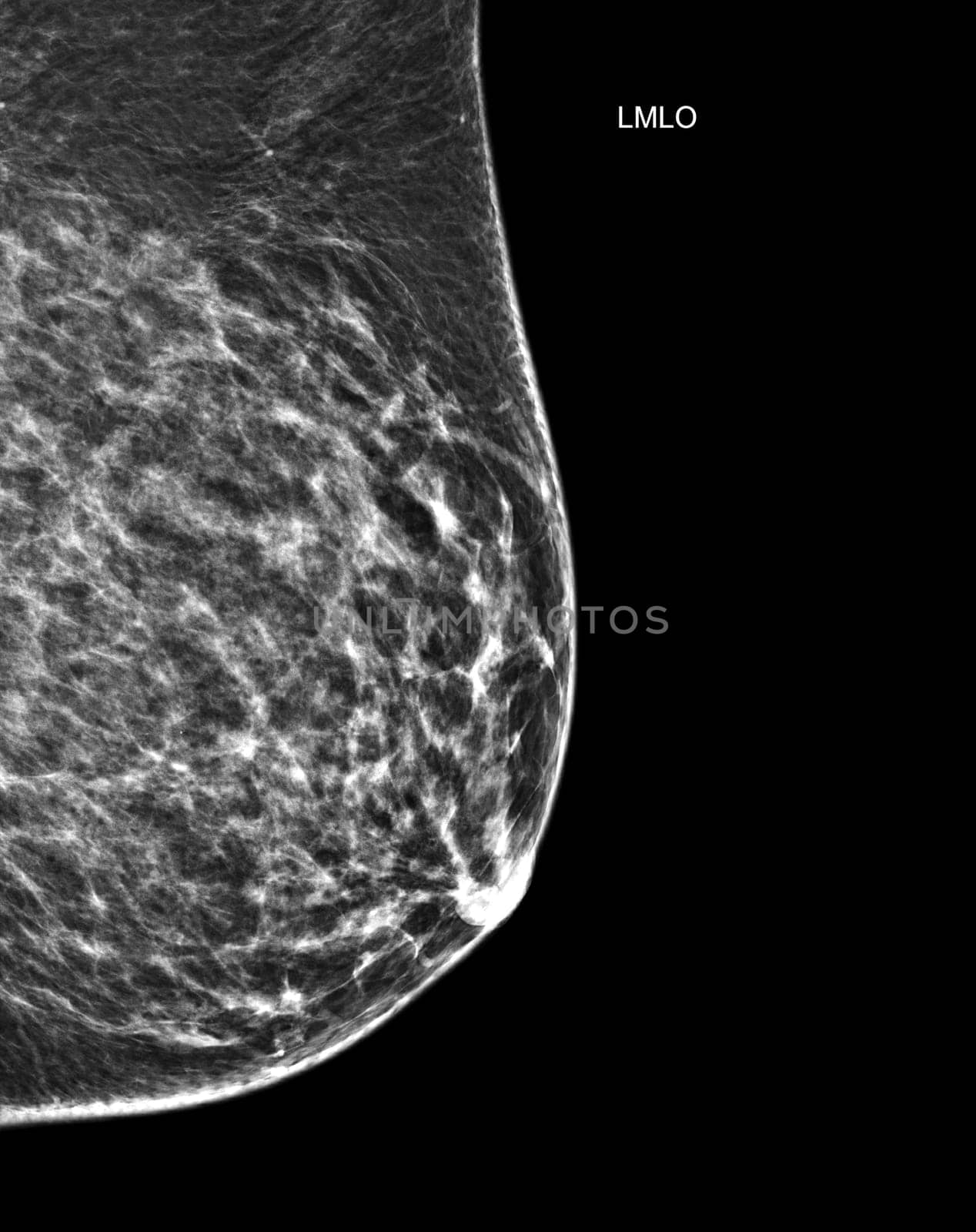 X-ray Digital Mammogram or mammography of both side breast Standard views are mediolateral oblique (MLO) views for screening Breast cancer and evidence of malignancy .