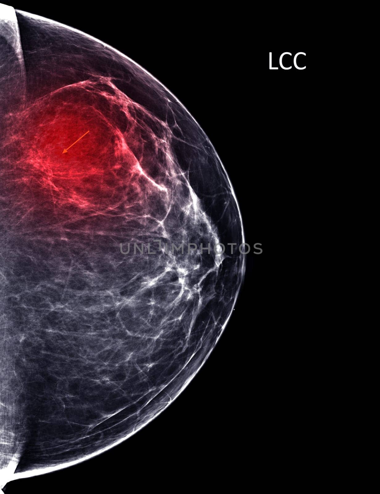 X-ray Digital Mammogram or mammography of both side breast Standard views are bilateral craniocaudal (CC) for screening Breast cancer and evidence of malignancy .