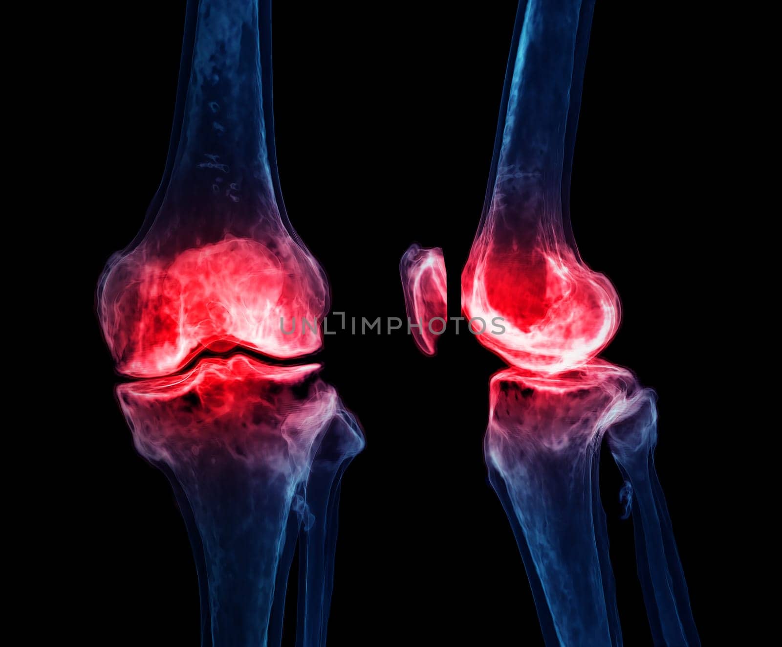 3d renderering of the knee joint isolated on black background Showing pain area. by samunella