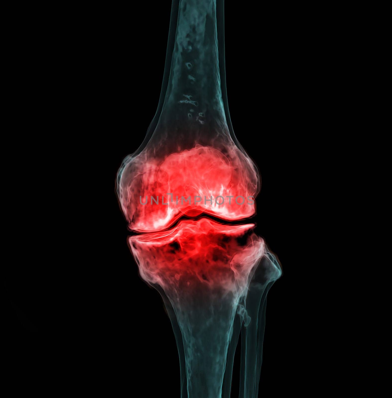 3d renderering of the knee joint isolated on black background Showing pain area.