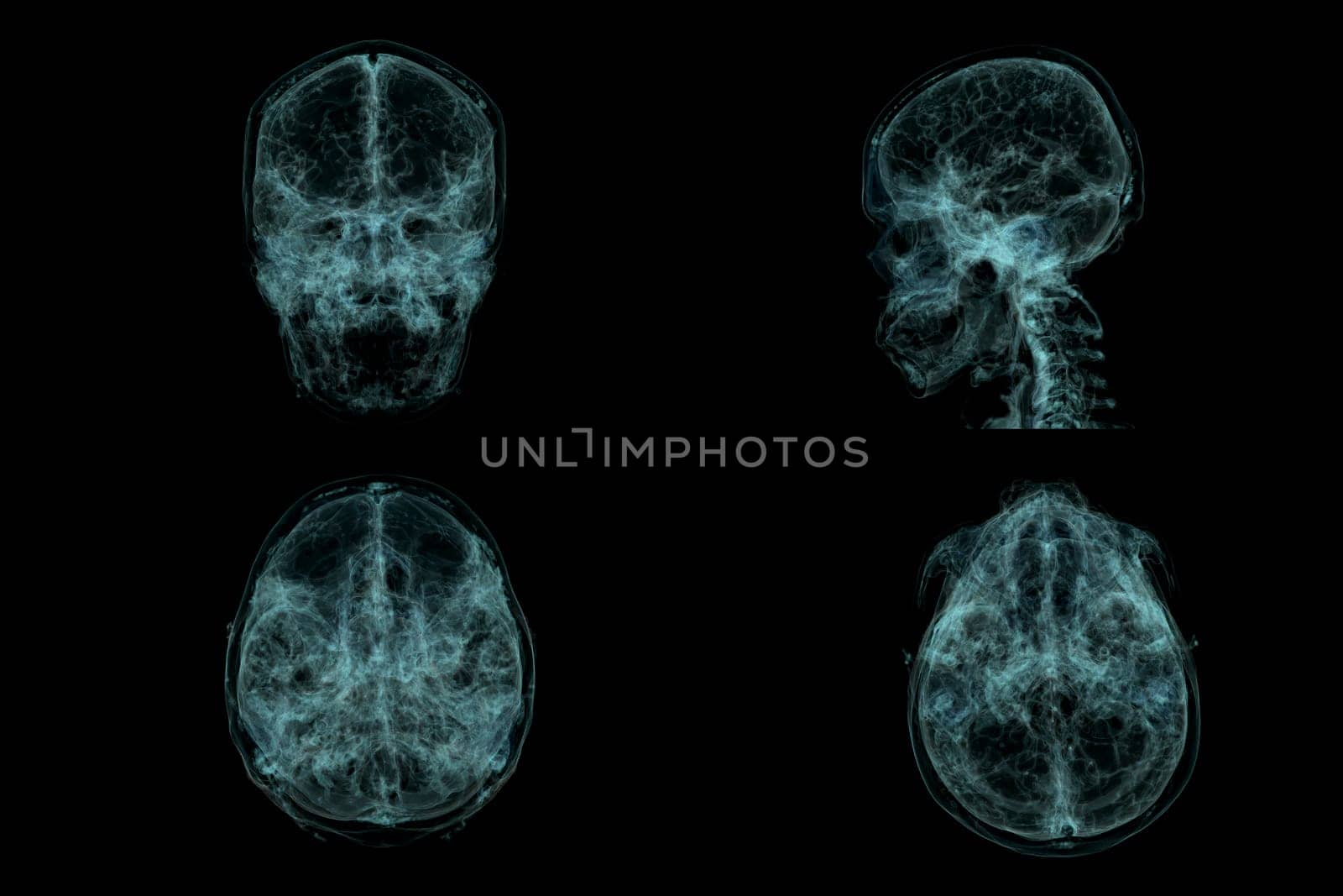 Collection of Human Skull, Brain by CT Scan. X-ray Visualization Inside Of Skull. 3D Illustration Render.