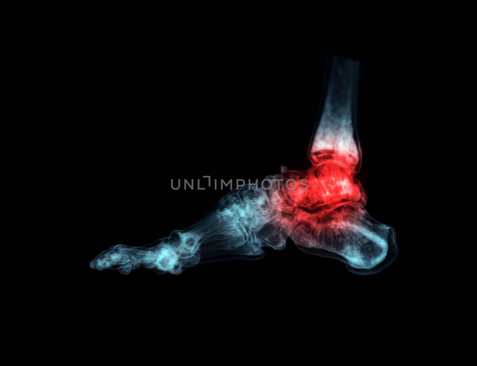 3D rendering of the foot bones for diagnosis bone fracture and rheumatoid arthritis from CT scannner.