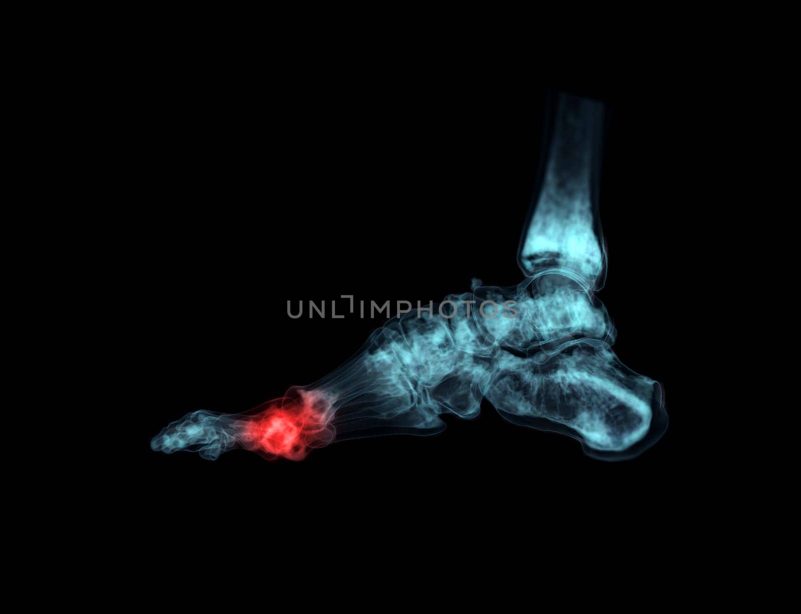 3D rendering of the foot bones for diagnosis bone fracture and rheumatoid arthritis from CT scannner.