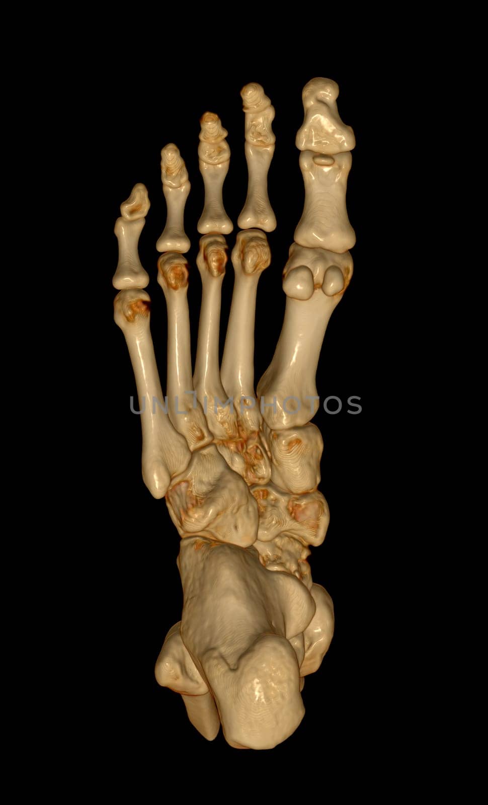 3D rendering of the foot bones for diagnosis bone fracture and rheumatoid arthritis from CT scannner.