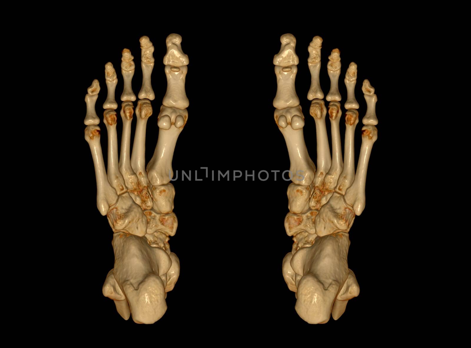 3D rendering of the foot bones for diagnosis bone fracture and rheumatoid arthritis from CT scannner.