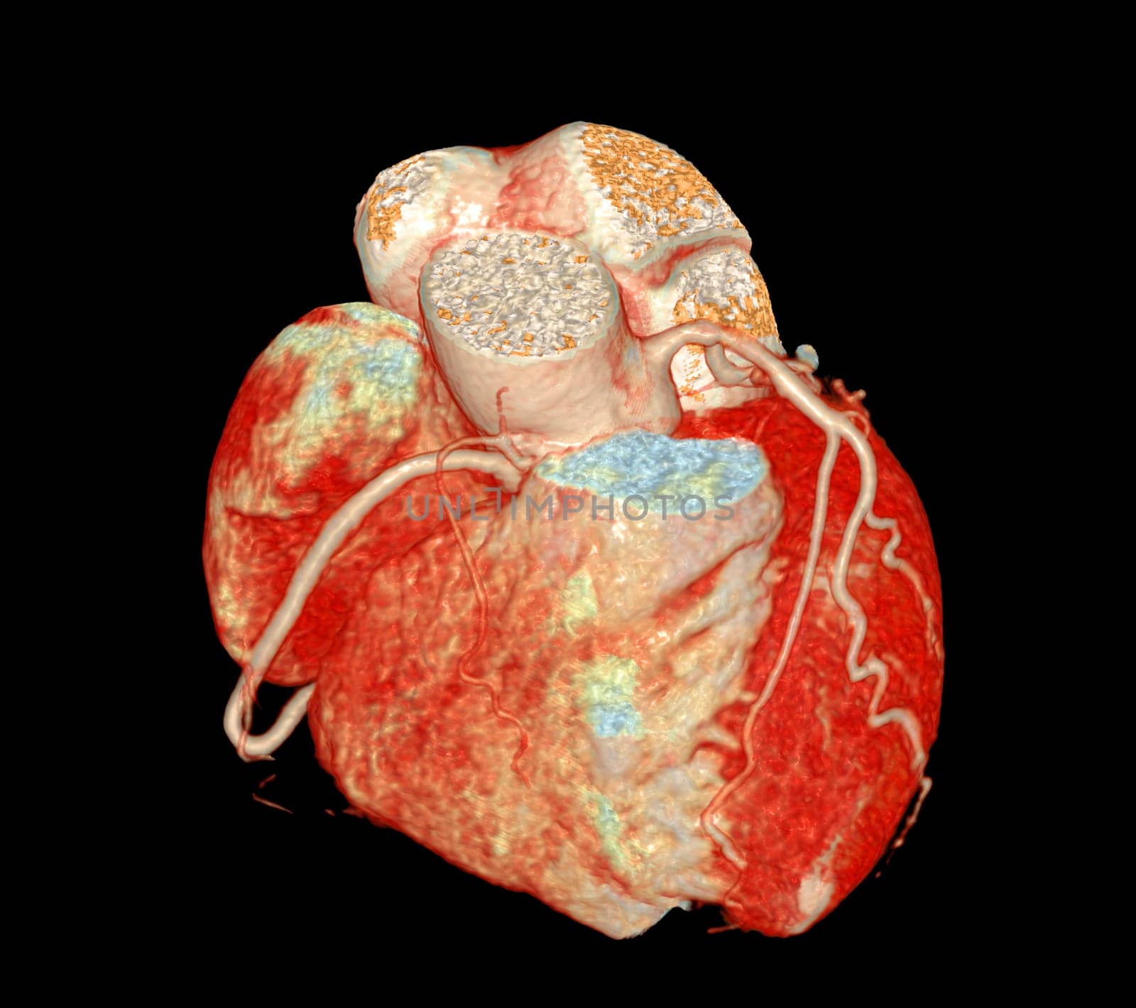 CT Cardiac 3D or CTA coronary artery for prevention and screening coronary artery diseases. by samunella