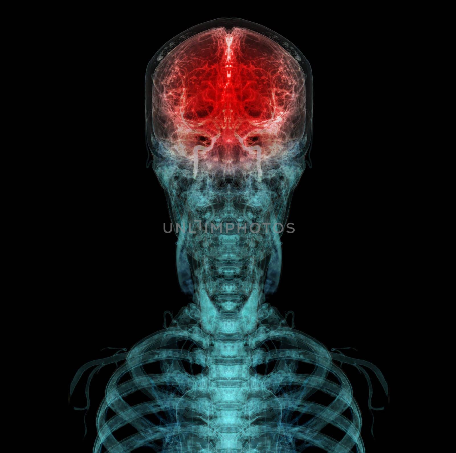 3D rendered medically accurate illustration of the cerebral artery of the head by samunella