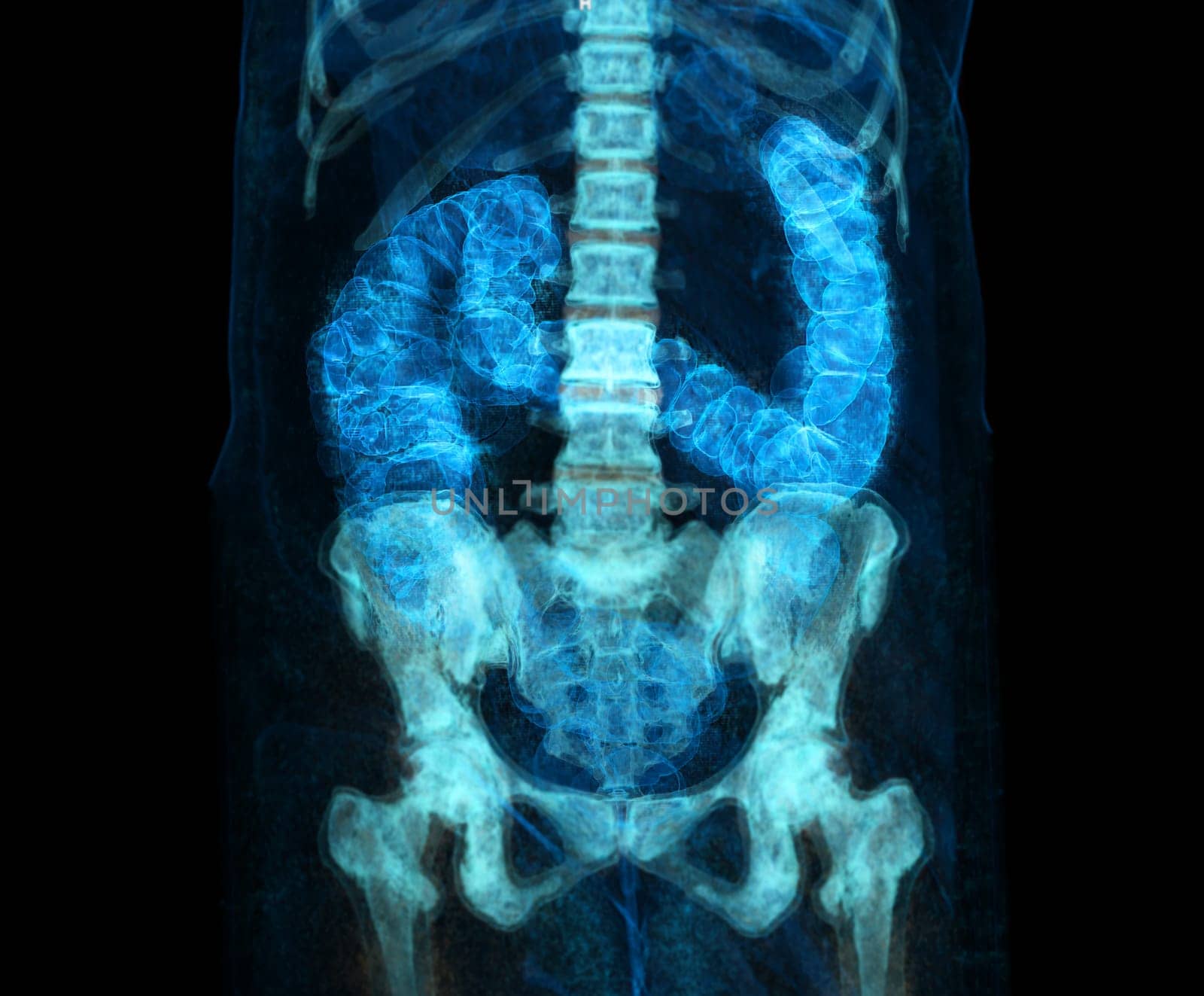 CT colonography or CT Scan of Colon 3D Rendering image for screening colorectal cancer. Check up Screening Colon Cancer. by samunella