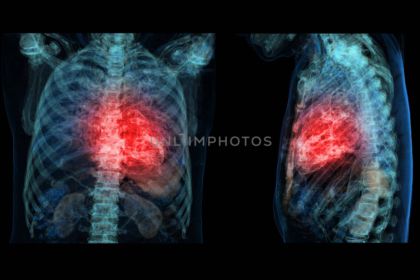 Human heart attack pain as an anatomy medical disease concept with a person suffering from a cardiac illness as a painful coronary event with 3D illustration by samunella