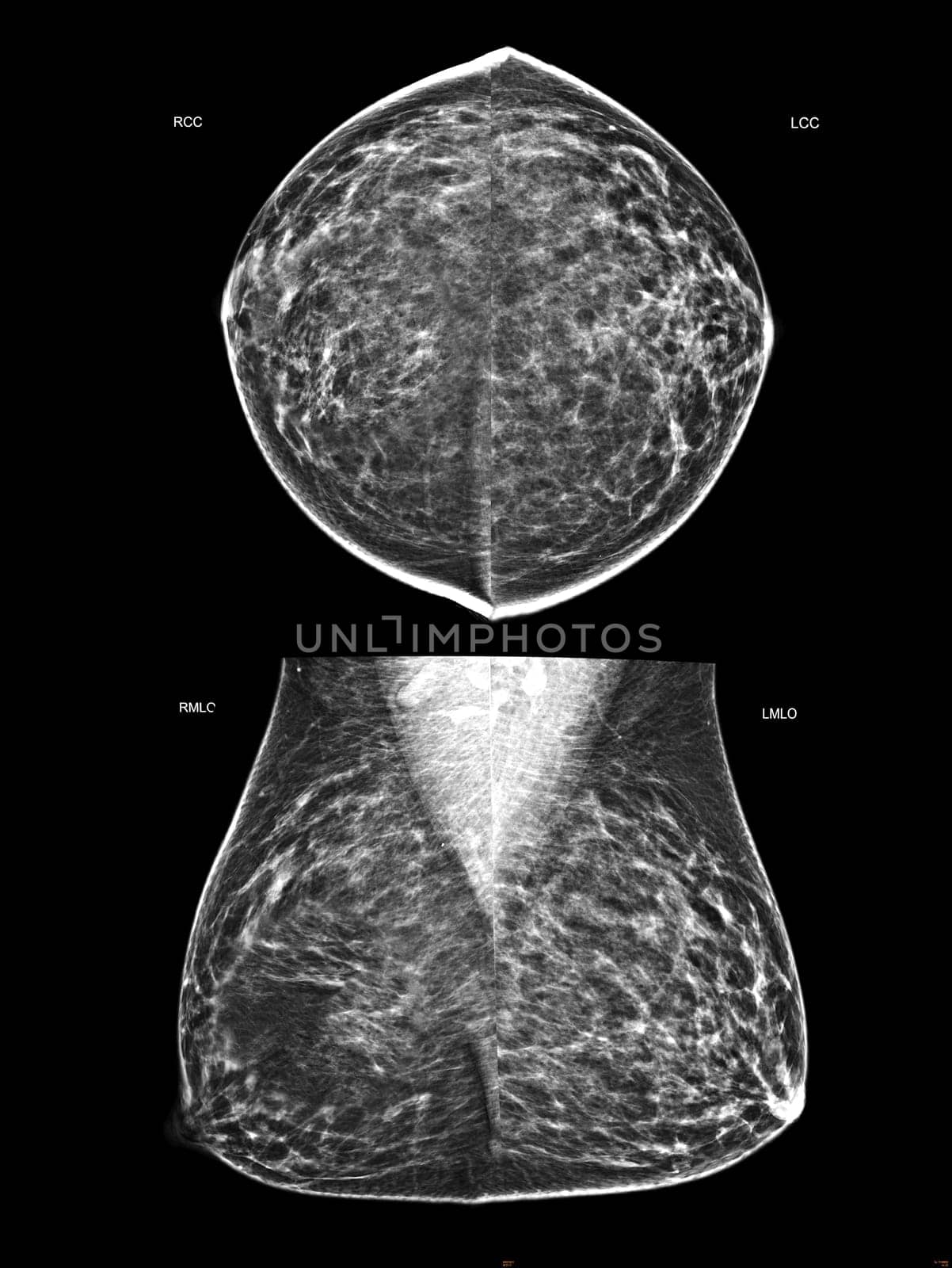 X-ray Digital Mammogram or mammography of both side breast Standard views are bilateral craniocaudal (CC) for screening Breast cancer and evidence of malignancy .