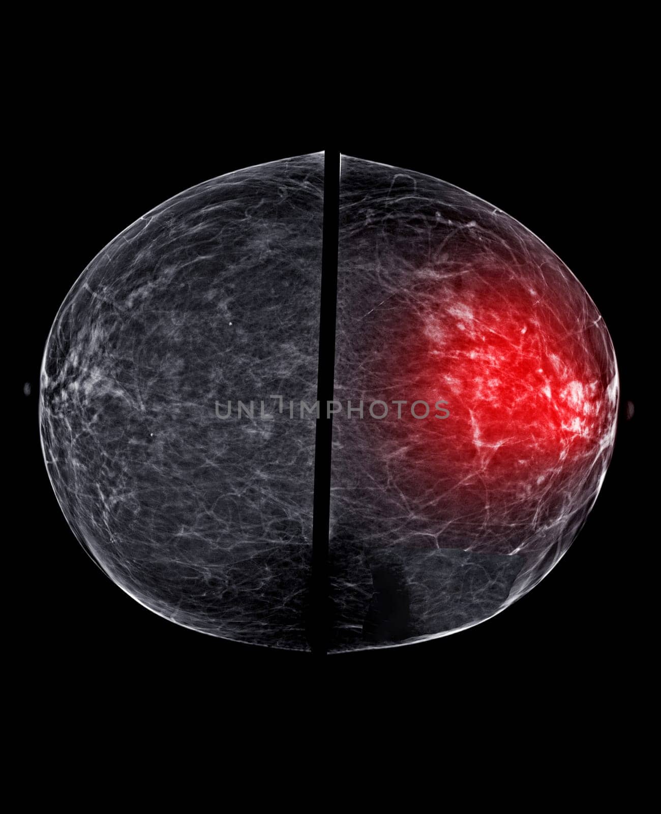 X-ray Digital Mammogram or mammography of both side breast Standard views are bilateral craniocaudal (CC) for screening Breast cancer and evidence of malignancy .