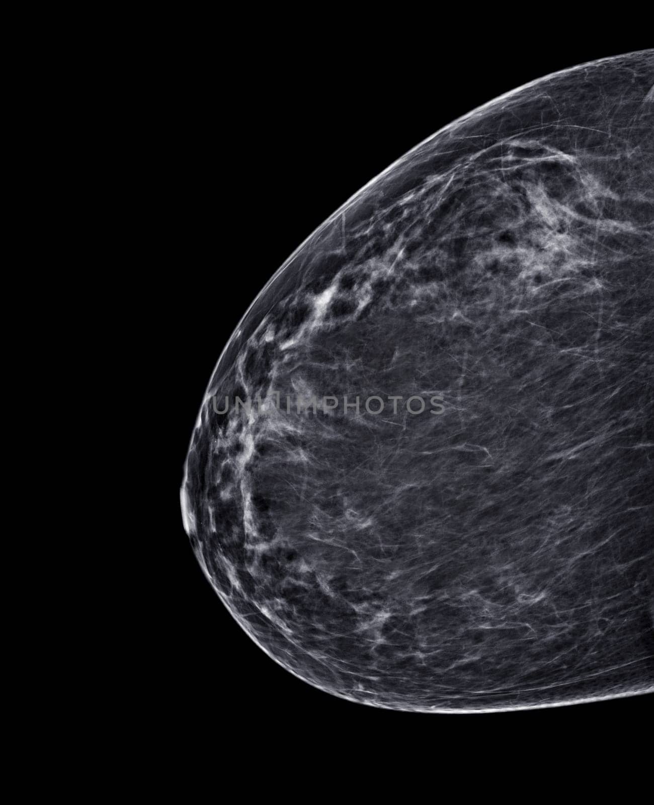 X-ray Digital Mammogram or mammography of both side breast Standard views are bilateral craniocaudal (CC) for screening Breast cancer and evidence of malignancy .