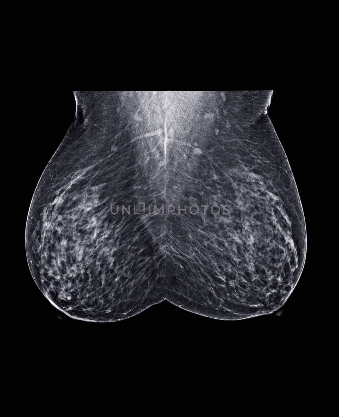 X-ray Digital Mammogram or mammography of both side breast Standard views are mediolateral oblique (MLO) views for screening Breast cancer and evidence of malignancy .