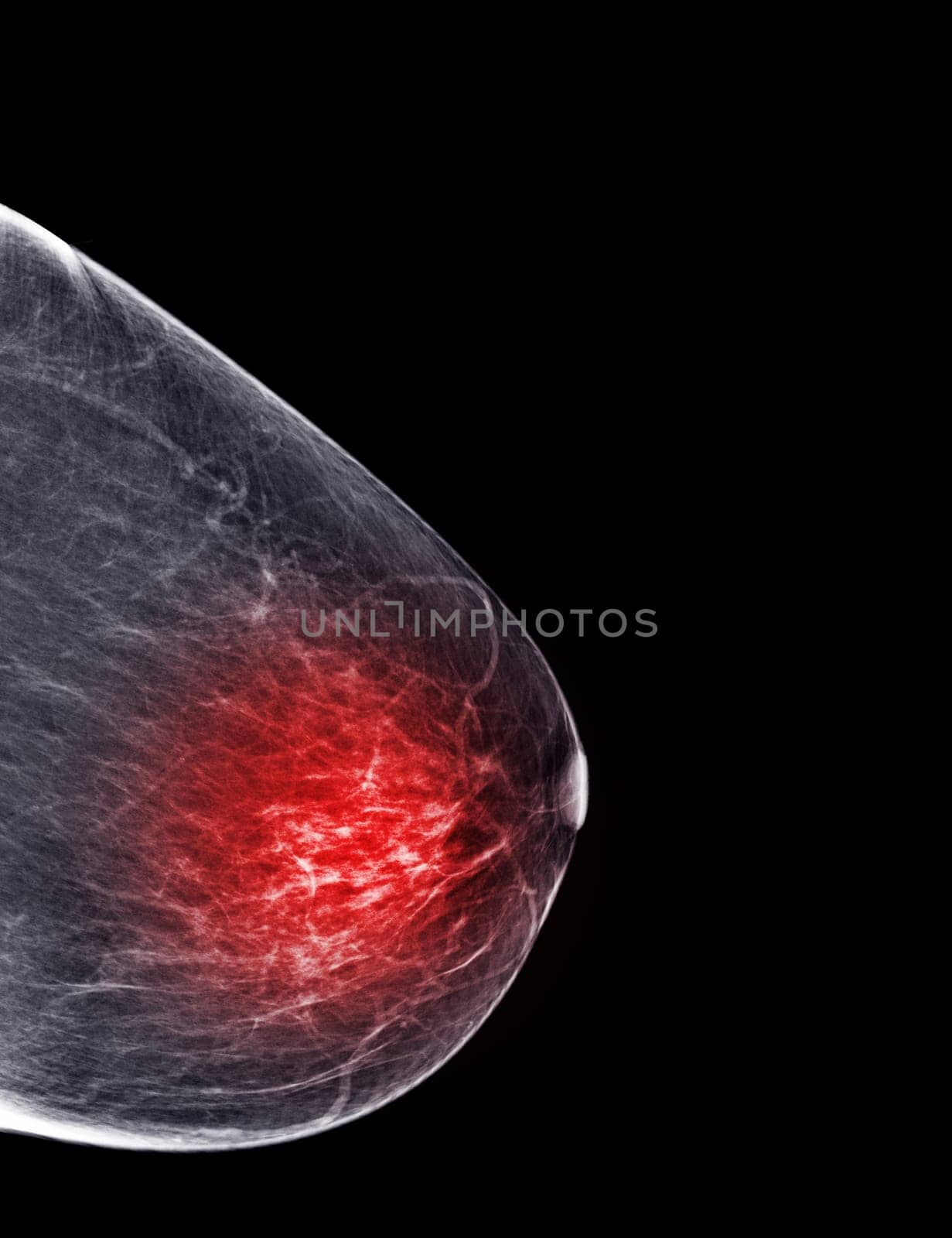 X-ray Digital Mammogram or mammography of both side breast Standard views are bilateral craniocaudal (CC) for screening Breast cancer and evidence of malignancy .