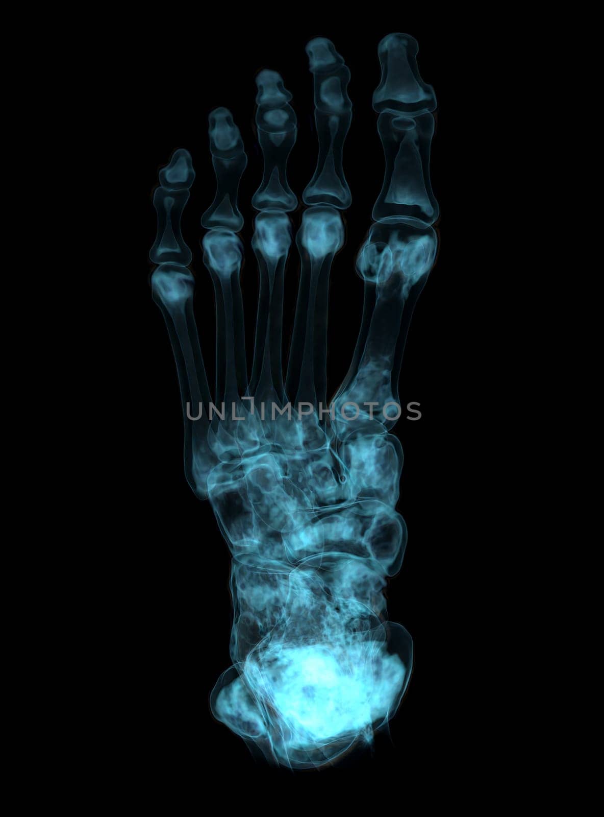 3D rendering of the foot bones for diagnosis bone fracture and rheumatoid arthritis from CT scannner.