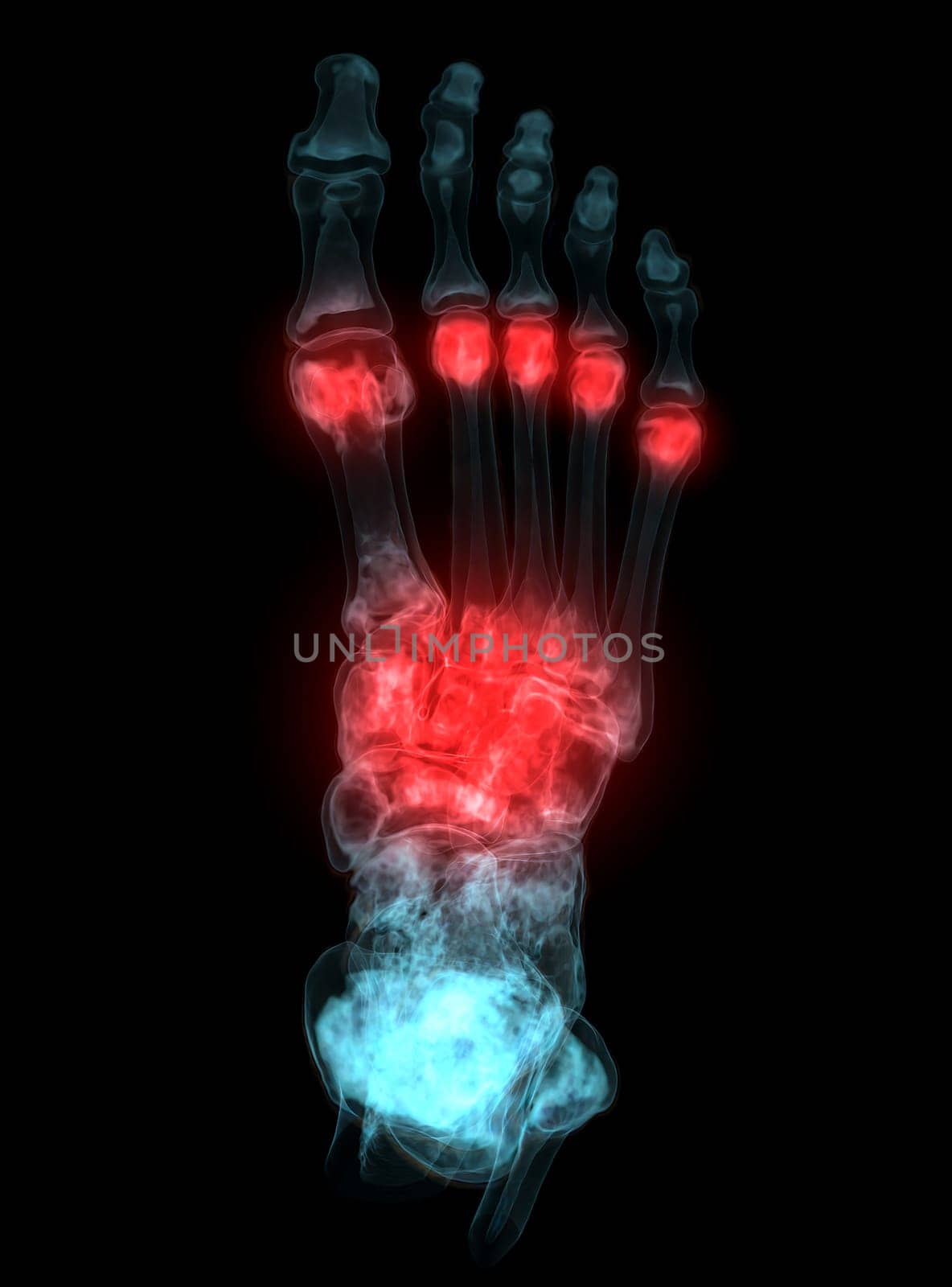 3D rendering of the foot bones for diagnosis bone fracture and rheumatoid arthritis from CT scannner.