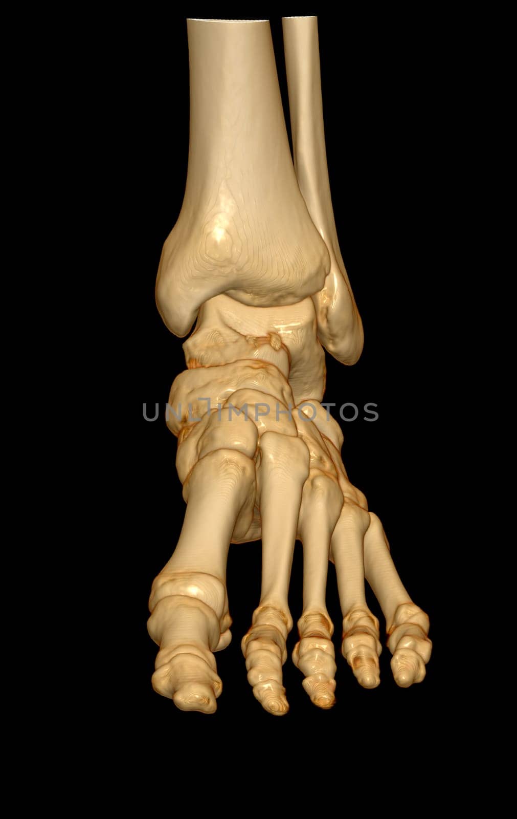 3D rendering of the foot bones for diagnosis bone fracture and rheumatoid arthritis from CT scannner.