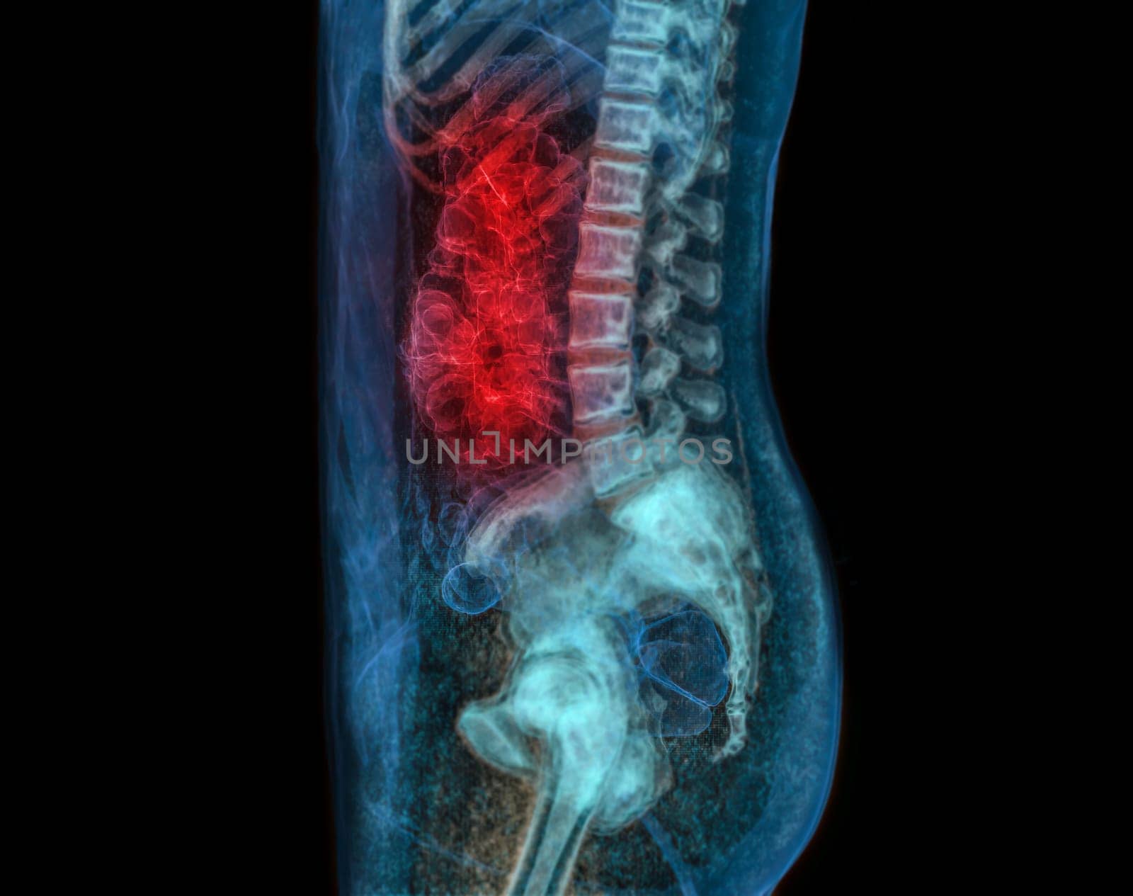 CT colonography or CT Scan of Colon 3D Rendering image for screening colorectal cancer. Check up Screening Colon Cancer.