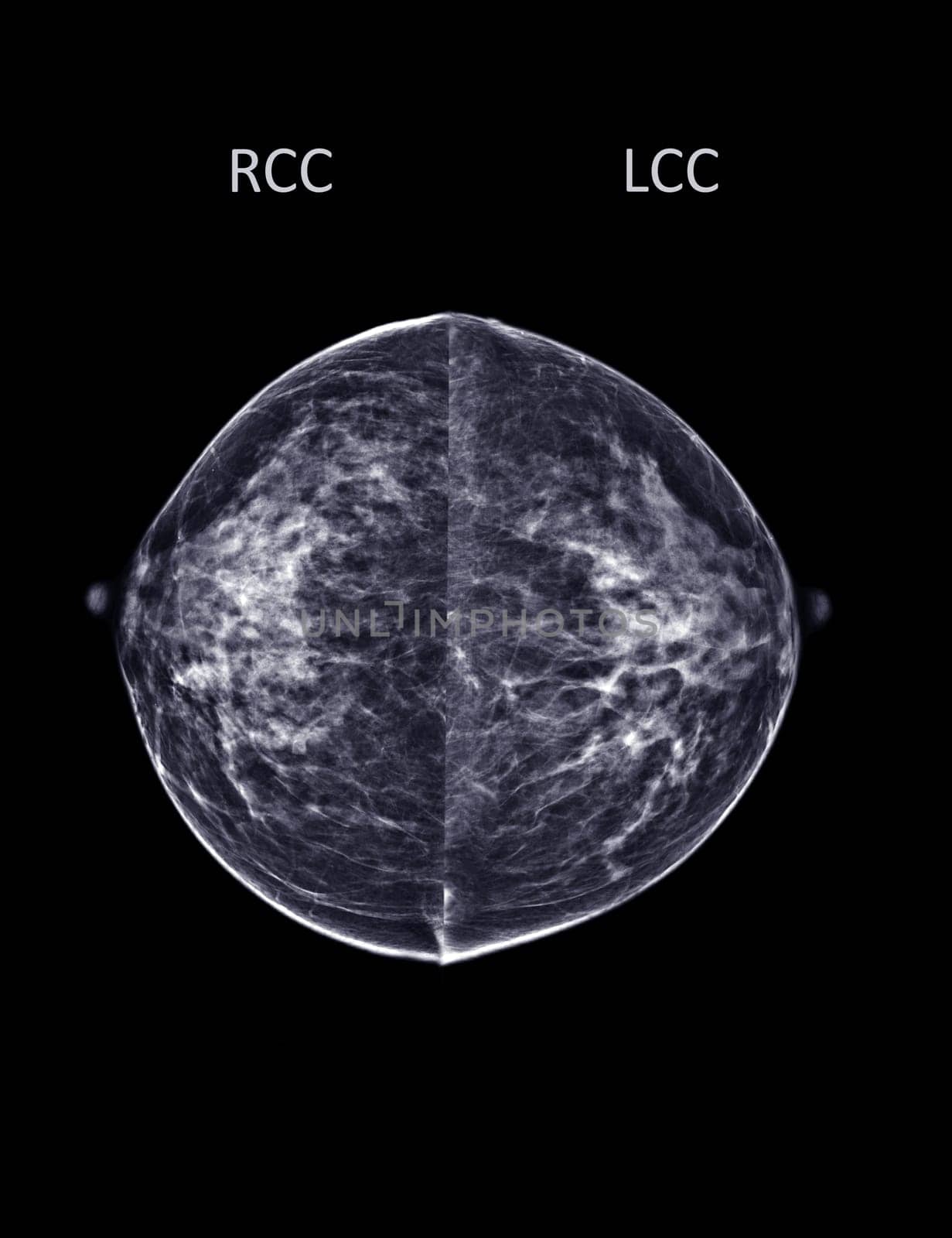 X-ray Digital Mammogram or mammography of both side breast Standard views are bilateral craniocaudal (CC) for screening Breast cancer and evidence of malignancy .