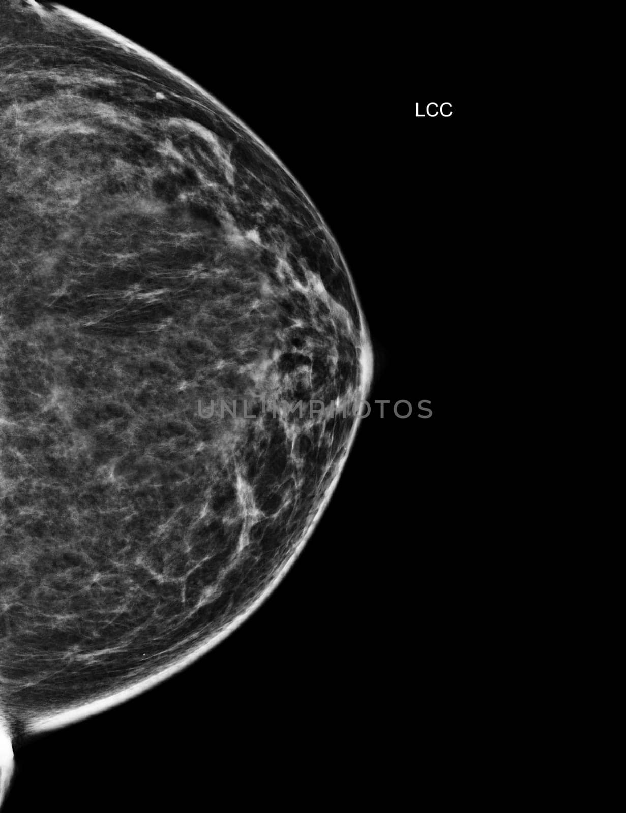 X-ray Digital Mammogram or mammography of both side breast Standard views are bilateral craniocaudal (CC) for screening Breast cancer and evidence of malignancy .