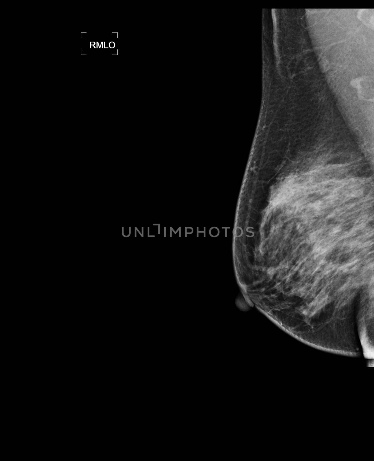 X-ray Digital Mammogram or mammography of both side breast showing benign tumor BI-RADS 3 should be checked once a year.