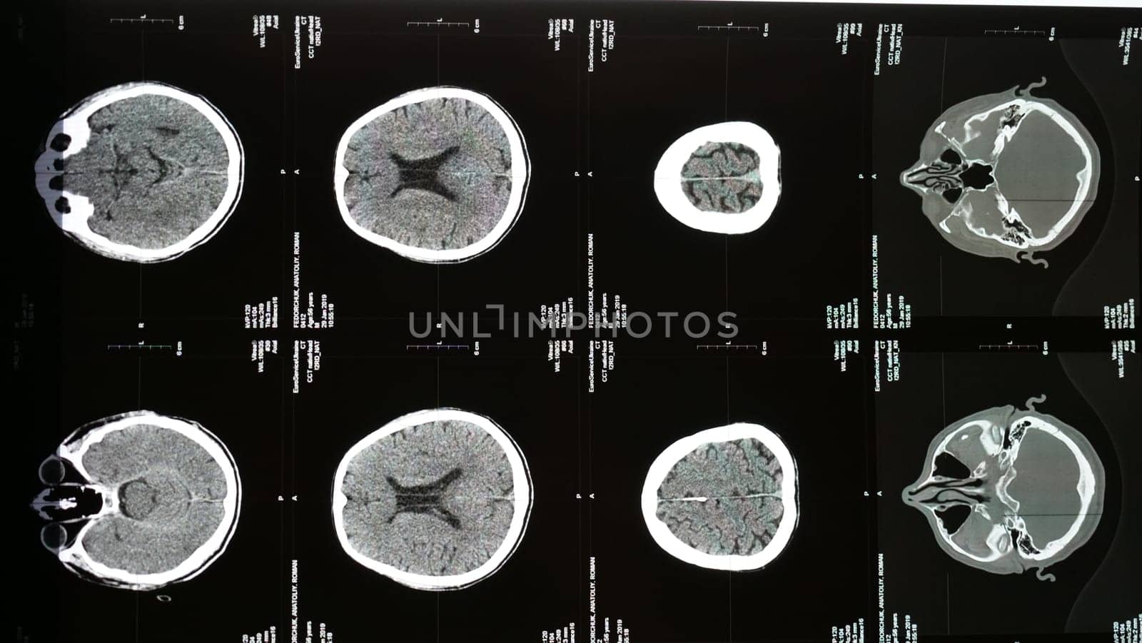 Magnetic resonance imaging of the brain from different sides, traumatic brain injury an 60 old male patient in the hospital, showing that the brain is affected. Examination by a neurologist, vertical