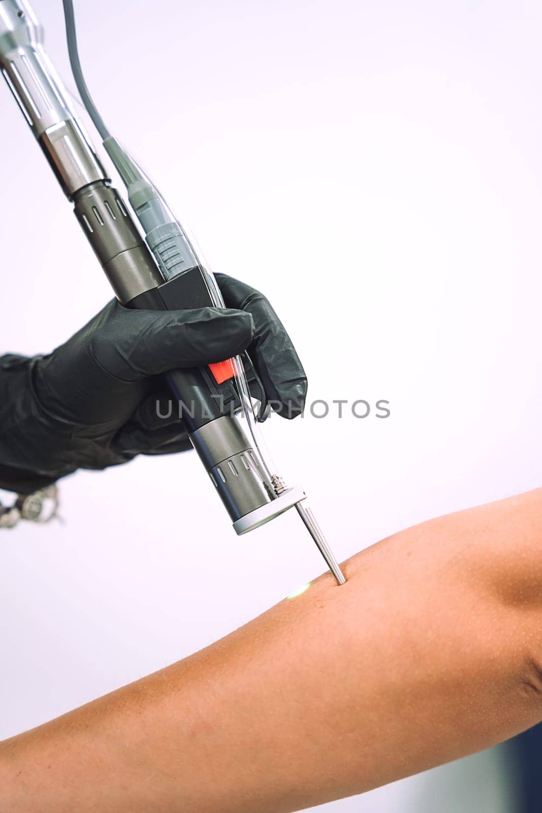 Close up shot of gloved hand with the laser hair removal machine's handpiece along woman hand. Alexandrite laser techhnology removing hair. Beauty procedureBeauty technology concept