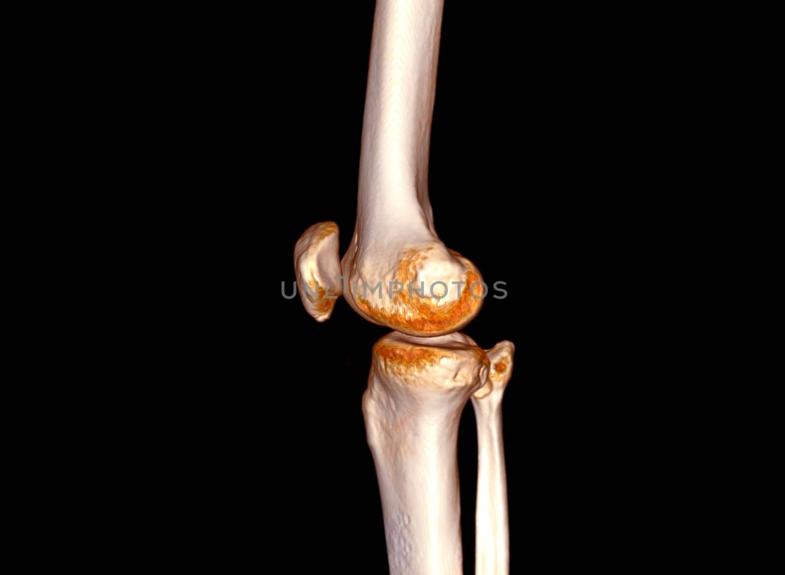 CT Scan of Knee joint 3D rendering .